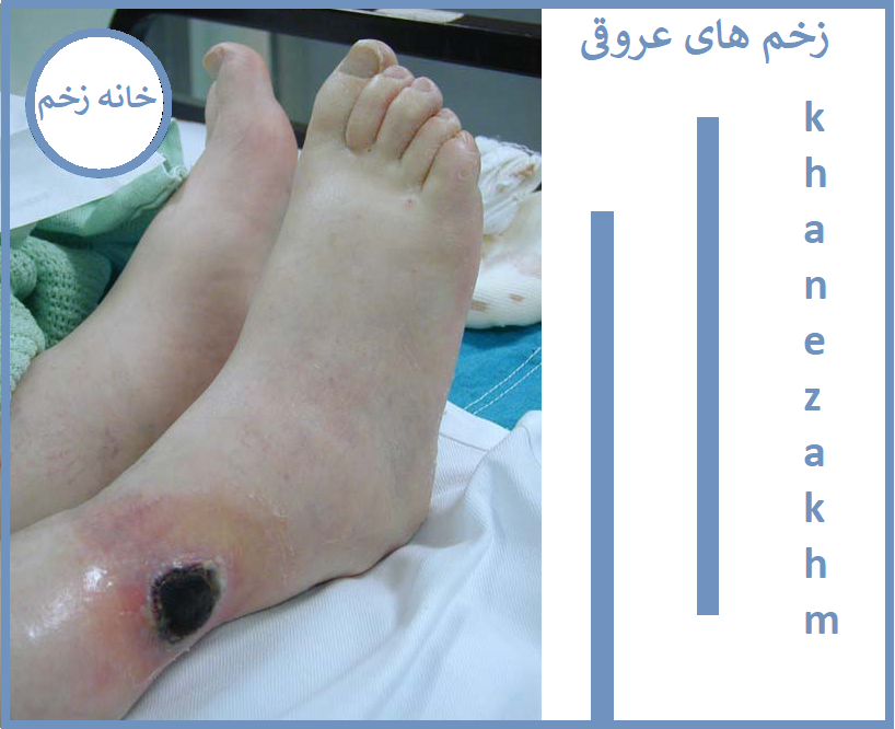 درمان زخم عروقی در مشهد