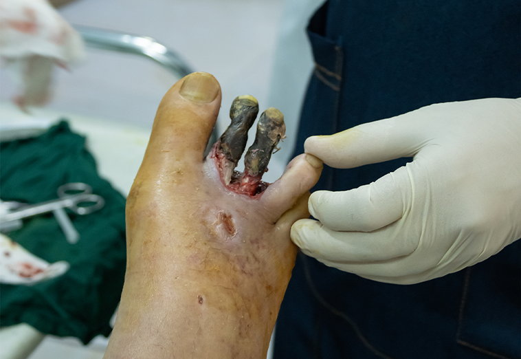 درمان زخم عروقی در مشهد